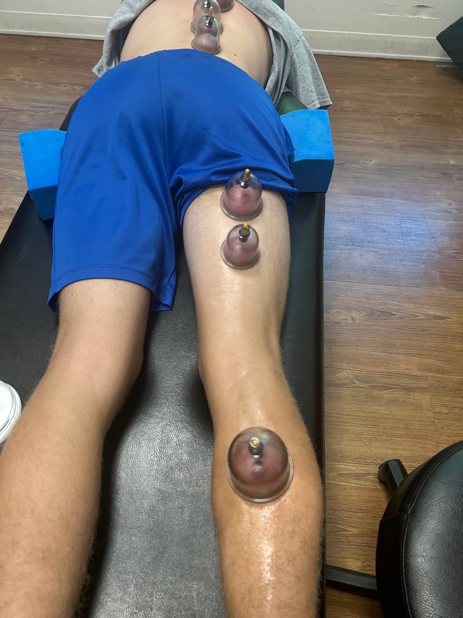 Localized cupping along the lateral leg (IT band)