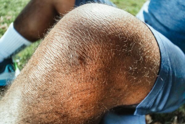 Persone With Bone on Bone Knee Pain