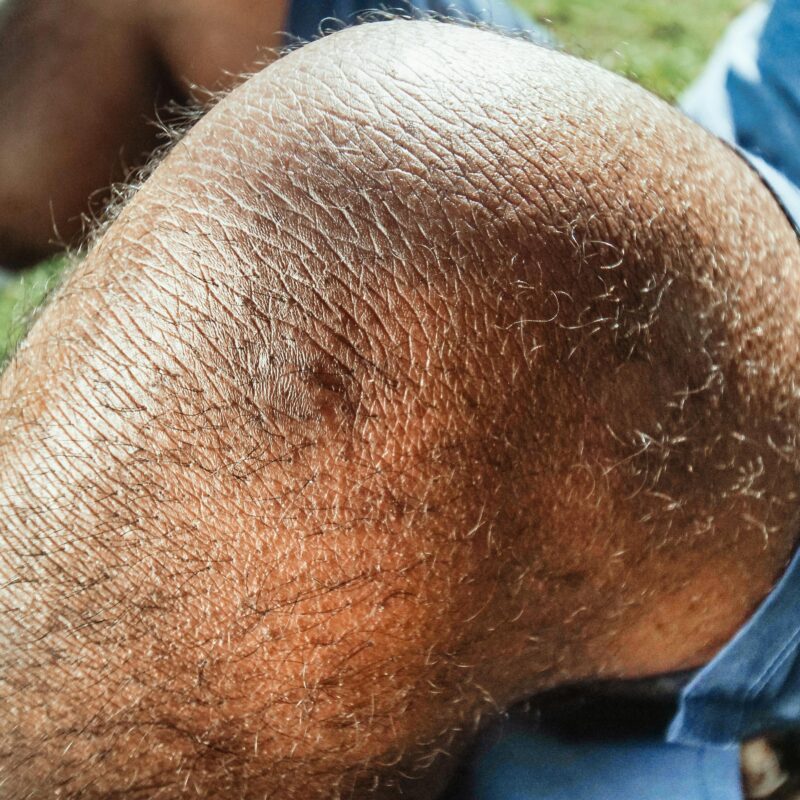 Persone With Bone on Bone Knee Pain